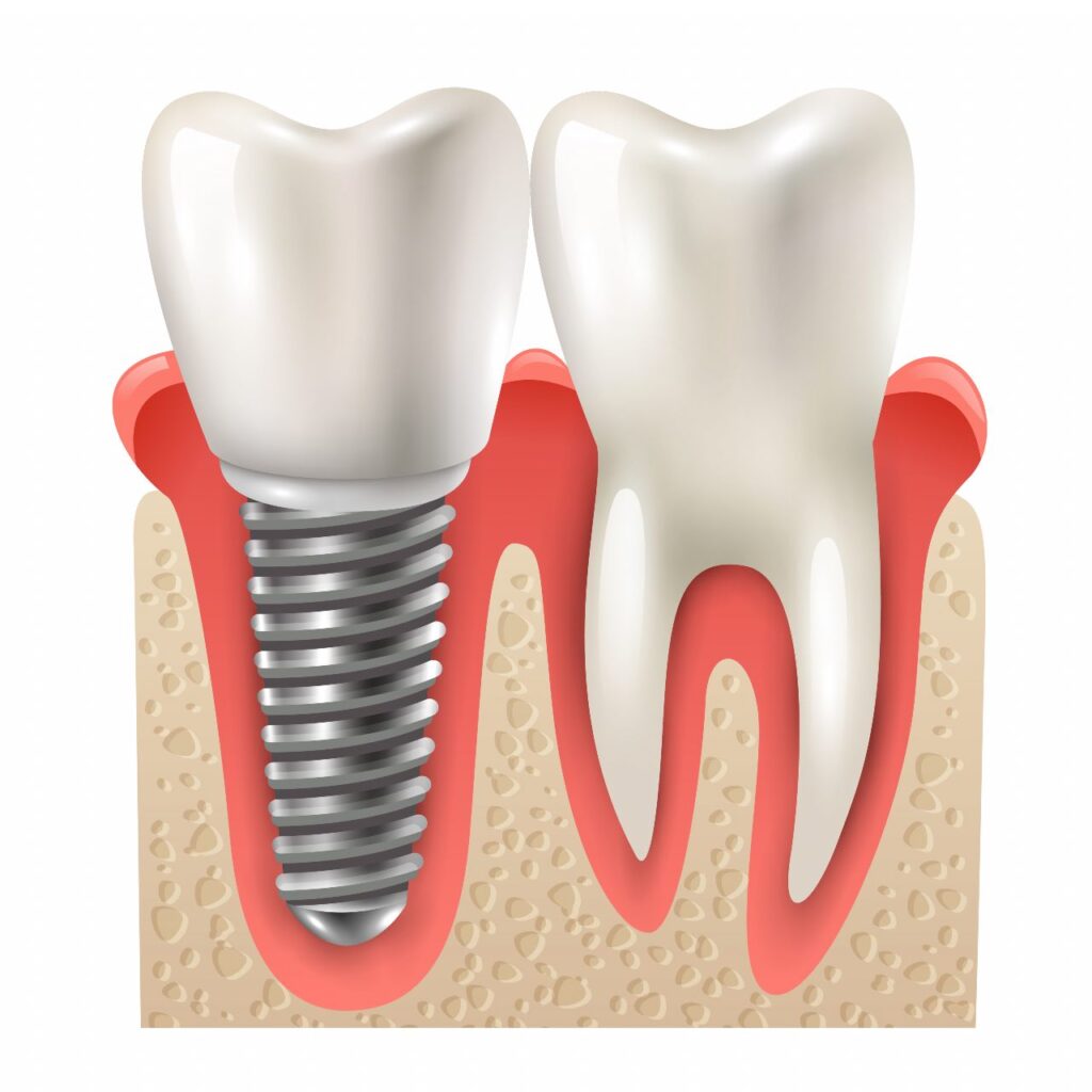 Dental Implant Surgery San Antonio
