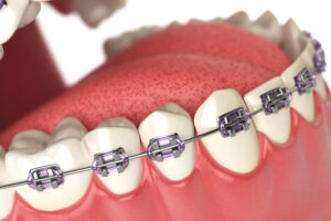 Orthodontic treatment in San Antonio - South Flores Dental
