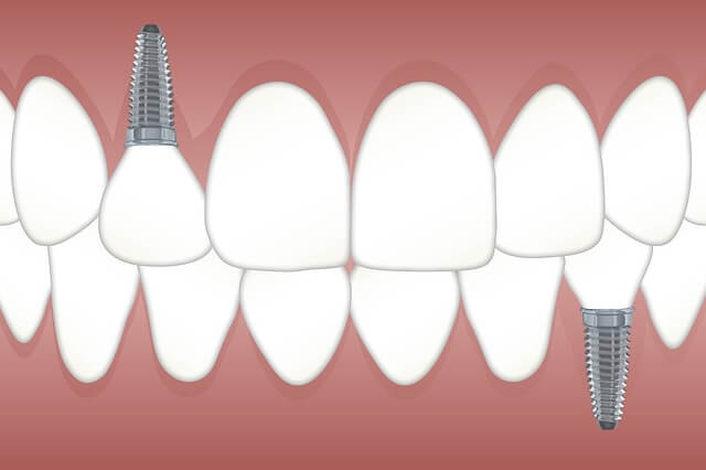 Tips for Dental Implant Recovery