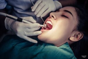 5 Mind-Blowing Benefits of Getting Microscope-Enhanced Root Canal Treatment