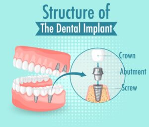 Dental Implants- Answering the Frequently Asked Questions
